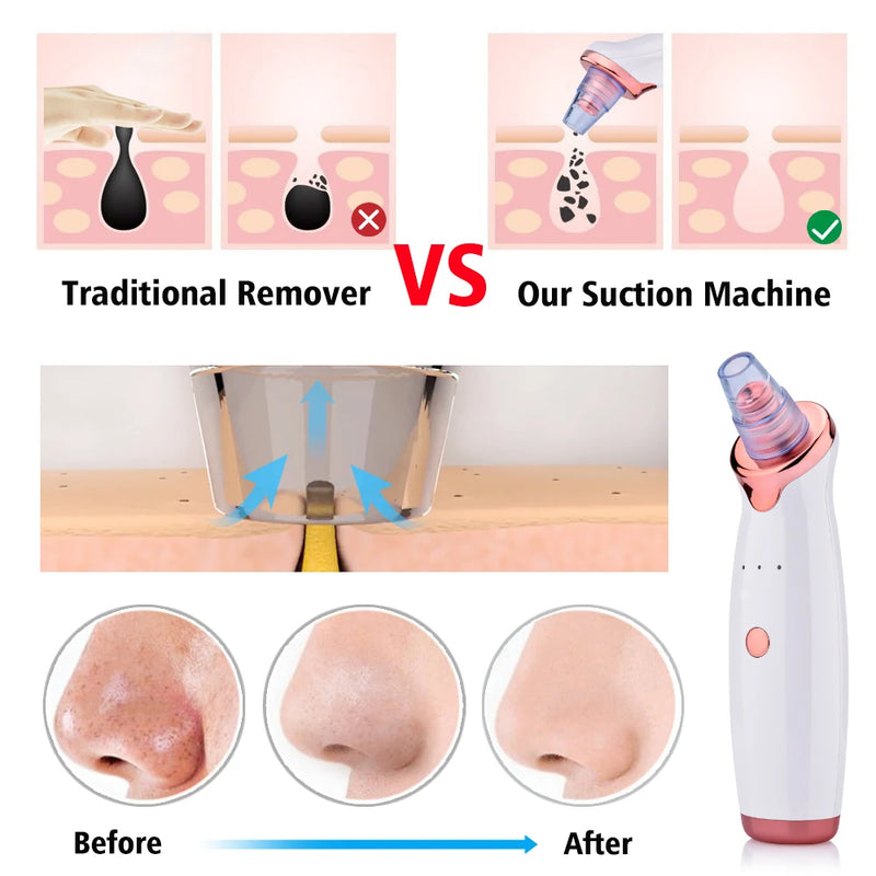 SILK ROLLA - Blackhead Remover and Vacuum Pore Cleaner Device, Electric Skin Vacuum Cleaner